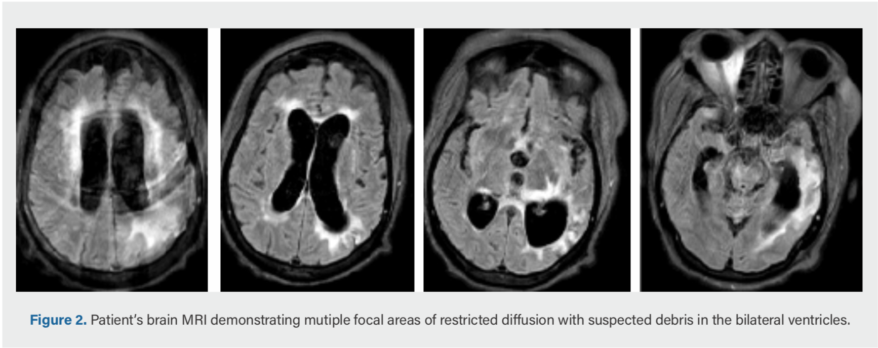 Cryptococcal Meningitis in a Patient With Cognitive Impairment and ...